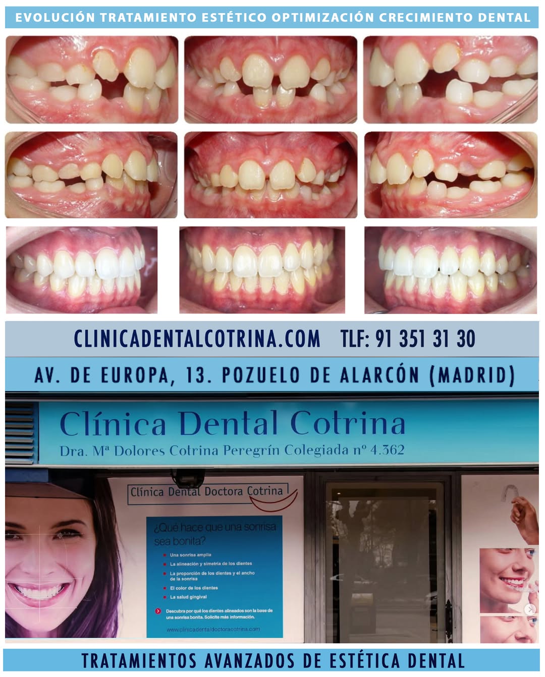 TRATAMIENTOS DE ESTÉTICA DENTAL PARA UN ÓPTIMO CRECIMIENTO DENTAL Es importante acudir a la consulta a temprana edad ya que hay muchos problemas que podemos resolver a tiempo, pues si lo hacemos más tarde los resultados no serán los mismos. Presentamos el caso de una paciente que acudió a la consulta pronto y gracias a ello pudimos actual a nivel óseo realizando un disyunción en el maxilar superior y un enderezamiento de la zona posterior en la arcada inferior, gracias a esto conseguimos el espacio suficiente para que las piezas permanentes erupcionaran en boca rodeadas de hueso de soporte. Una vez terminado su crecimiento y con todos los dientes en boca, pasamos a una segunda fase de tratamiento en la que colocamos alineados (ortodoncia invisible) y con la ayuda de microtornillos nivelamos el plano oclusal y conseguimos un engranaje correcto con una bonita estética. En definitiva, la paciente está muy contenta con los resultados obtenidos. … CLÍNICA DENTAL COTRINA. “SONRISAS PERFECTAS EN POZUELO DE ALARCÓN”. TRATAMIENTOS AVANZADOS DE ESTÉTICA DENTAL. Los tratamientos de estética dental buscan mejorar la apariencia de la sonrisa, corrigiendo imperfecciones como manchas, fracturas, malposiciones o asimetrías. Estos tratamientos pueden incluir carillas, blanqueamiento, ortodoncia, coronas estéticas y cirugía de encías, entre otros. Consúltenos. Dirección: Avenida de Europa, 13. 28224 Pozuelo de Alarcón. Teléfono: 91 351 31 30. https://clinicadentalcotrina.com TIPOS DE TRATAMIENTOS: * #Ortodoncia: Corrige la posición de los dientes y los problemas óseos cuando el niño esta en crecimiento o si no está en crecimiento con cirugía #ortognática, para así lograr una sonrisa más armoniosa y una mejor mordida. * Diseño de sonrisa: Es un enfoque integral que combina varios tratamientos para lograr una sonrisa estética y personalizada, considerando la forma, tamaño, color y posición de los dientes, así como la línea de la encía. * #Carillas dentales: Son finas láminas que se adhieren a la parte frontal del diente para mejorar su forma, tamaño, color o posición. * #Coronas o Fundas : Cubren el diente dañado o deteriorado, restaurando su forma, tamaño y función, además de mejorar su apariencia estética. * #Blanqueamiento dental: Aclara el color de los dientes y unifica dicha tonalidad en toda la dentadura. * Cirugía plástica en la encía (Gingivoplastia) junto a la Periodoncia : Permite remodelar la encía para corregir problemas como una sonrisa gingival (demasiado visible) o encías irregulares y a la vez tratar cualquier tipo de enfermedad de la encía. * Reconstrucciones estéticas: Reparan dientes dañados por caries, fracturas o desgaste, utilizando materiales que imitan la apariencia natural del diente. #esteticadental #blanqueamientodental #diseñodesonrisa #dentistaspozuelo #clinicasdentalespozuelo #gingivoplastia #periodoncia #ortodonciadental #blanqueardientes #tratamientosdentales #disyuccionmaxilar #asimetriadental #alineadoresdentales