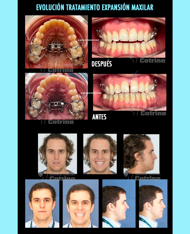CASO DE CLASE III CON EXPANSIÓN MAXILAR SUPERIOR Y RETRUSIÓN ARCADA INFERIOR. (Clinica Dental Cotrina, Tratamientos Integrales Bucodentales a nivel Estético, Óseo y Dentario). #expansionmaxilar #DisyuntorMaxilar #RetrusiónArcadas #Ortodoncia #MotionClaseIII #MaloclusiónBucoDental #CorrectorDental #blanqueamientodental En este caso de paciente adulto que acude a la consulta para realizarse tratamiento de ortodoncia, el motivo de consulta fue que quería mejorar su sonrisa. Tras el estudio profundo e individualizado realizado a nuestro paciente le aconsejamos una disyunción del maxilar superior ya que su hueso maxilar era más estrecho que su mandíbula y además nos comentaba que tenia problemas para dormir en cuanto a la respiración con ronquidos fuertes y desviación del tabique nasal, tras realizarse un estudio de su respiración con poligrafía respiratoria el paciente referia apnea de sueño muy leve y fuertes ronquidos. Al ver que el hueso maxilar era pequeño de tamaño quisimos recomendarle expansión del hueso superior con un disyuntor anclado al paladar con microtornillos para tener un hueso más ancho, poder mover los dientes superiores mejor en ese hueso y mejorar la respiración ya que es el suelo de las fosas nasales. Como además tenia la arcada inferior más adelantada tambien quisimos realizarle un tratamiento previo a Motion clase III que son unas "barras metálicas" que se cementan en la zona posterointerior para poder retruir o "llevar hacia atrás" a esa zona mediante elásticos intermaxilares, una vez conseguido ese movimiento fue cuando realizamos la disyunción y aprovechando el anclaje posterosuperior terminamos de retruir o llevar hacia atrás la zona anteroinferior cerrando los espacios generados de la retrusión (movimiento hacia atrás) de la arcada inferior en su zona posterior cierre de los espacios generados delante de las barras metálicas. Finalmente observamos unos resultados muy buenos no solo a nivel estéticos, óseo y dentario sino también en la respiración y salud del paciente. Este tratamiento duró solamente un año y medio y el paciente nos expresó su satisfacción a través un video testimonial que publicaremos próximamente. CLÍNICA DENTAL COTRINA. TRATAMIENTOS AVANZADOS DE ESTÉTICA DENTAL EN POZUELO DE ALARCÓN (MADRID). Los tratamientos de estética dental buscan mejorar la apariencia de la sonrisa, corrigiendo imperfecciones como manchas, fracturas, malposiciones o asimetrías. Estos tratamientos pueden incluir carillas, blanqueamiento, ortodoncia, coronas estéticas y cirugía de encías, entre otros.