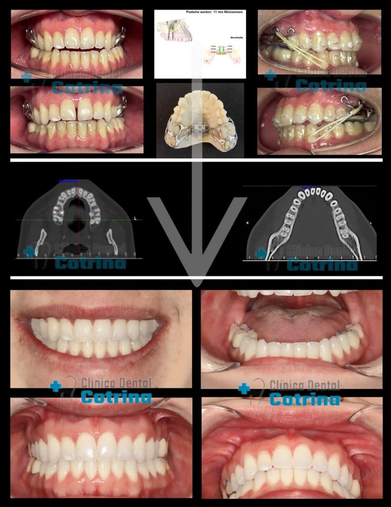 CASO DE CLASE III CON EXPANSIÓN MAXILAR SUPERIOR Y RETRUSIÓN ARCADA INFERIOR. (Clinica Dental Cotrina, Tratamientos Integrales Bucodentales a nivel Estético, Óseo y Dentario). #expansionmaxilar #DisyuntorMaxilar #RetrusiónArcadas #Ortodoncia #MotionClaseIII #MaloclusiónBucoDental #CorrectorDental #blanqueamientodental En este caso de paciente adulto que acude a la consulta para realizarse tratamiento de ortodoncia, el motivo de consulta fue que quería mejorar su sonrisa. Tras el estudio profundo e individualizado realizado a nuestro paciente le aconsejamos una disyunción del maxilar superior ya que su hueso maxilar era más estrecho que su mandíbula y además nos comentaba que tenia problemas para dormir en cuanto a la respiración con ronquidos fuertes y desviación del tabique nasal, tras realizarse un estudio de su respiración con poligrafía respiratoria el paciente referia apnea de sueño muy leve y fuertes ronquidos. Al ver que el hueso maxilar era pequeño de tamaño quisimos recomendarle expansión del hueso superior con un disyuntor anclado al paladar con microtornillos para tener un hueso más ancho, poder mover los dientes superiores mejor en ese hueso y mejorar la respiración ya que es el suelo de las fosas nasales. Como además tenia la arcada inferior más adelantada tambien quisimos realizarle un tratamiento previo a Motion clase III que son unas "barras metálicas" que se cementan en la zona posterointerior para poder retruir o "llevar hacia atrás" a esa zona mediante elásticos intermaxilares, una vez conseguido ese movimiento fue cuando realizamos la disyunción y aprovechando el anclaje posterosuperior terminamos de retruir o llevar hacia atrás la zona anteroinferior cerrando los espacios generados de la retrusión (movimiento hacia atrás) de la arcada inferior en su zona posterior cierre de los espacios generados delante de las barras metálicas. Finalmente observamos unos resultados muy buenos no solo a nivel estéticos, óseo y dentario sino también en la respiración y salud del paciente. Este tratamiento duró solamente un año y medio y el paciente nos expresó su satisfacción a través un video testimonial que publicaremos próximamente. CLÍNICA DENTAL COTRINA. TRATAMIENTOS AVANZADOS DE ESTÉTICA DENTAL EN POZUELO DE ALARCÓN (MADRID). Los tratamientos de estética dental buscan mejorar la apariencia de la sonrisa, corrigiendo imperfecciones como manchas, fracturas, malposiciones o asimetrías. Estos tratamientos pueden incluir carillas, blanqueamiento, ortodoncia, coronas estéticas y cirugía de encías, entre otros. 