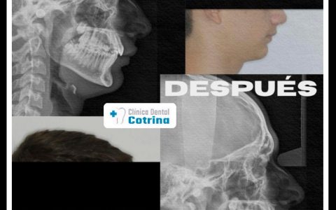 TRATAMIENTO DE ORTODONCIA FUNCIONAL DE ARCADA DENTAL, ORTOPEDIA MAXILAR. ORTODONCIA INTERCEPTIVA  CON DISYUCCION OSEA PARA AVANCE MANDIBULAR. TRATAMIENTOS DE ORTODONCIA ESTÉTICA EN POZUELO DE ALARCÓN. En este paciente hemos realizado una primera fase de disyunción o expansión ósea del maxilar que aumenta el espacio necesario para la erupción de las piezas permanentes en boca dentro de su hueso y no forzadas y también para mejorar la respiración. Después, en el pico de crecimiento, hemos favorecido el avance de su mandíbula (ortopedia) y realizado el tratamiento dentario (ortodóncico) para conseguir una buena funcionalidad, engranaje y estética dental. #OrtodonciaFuncional #CrecimientoPuberal #OrtopediaDentofacial #CasoClínico #OrtodonciaInterceptiva #OrtodonciaAdolesces #SaludDental #ortopediamaxilar