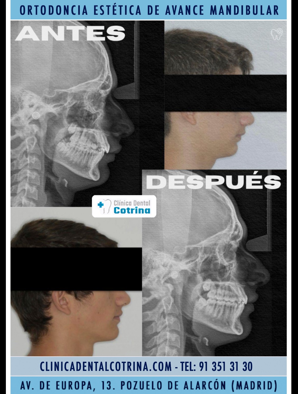 TRATAMIENTO DE ORTODONCIA FUNCIONAL DE ARCADA DENTAL, ORTOPEDIA MAXILAR. ORTODONCIA INTERCEPTIVA CON DISYUCCION OSEA PARA AVANCE MANDIBULAR. TRATAMIENTOS DE ORTODONCIA ESTÉTICA EN POZUELO DE ALARCÓN. En este paciente hemos realizado una primera fase de disyunción o expansión ósea del maxilar que aumenta el espacio necesario para la erupción de las piezas permanentes en boca dentro de su hueso y no forzadas y también para mejorar la respiración. Después, en el pico de crecimiento, hemos favorecido el avance de su mandíbula (ortopedia) y realizado el tratamiento dentario (ortodóncico) para conseguir una buena funcionalidad, engranaje y estética dental. #OrtodonciaFuncional #CrecimientoPuberal #OrtopediaDentofacial #CasoClínico #OrtodonciaInterceptiva #OrtodonciaAdolesces #SaludDental #ortopediamaxilar