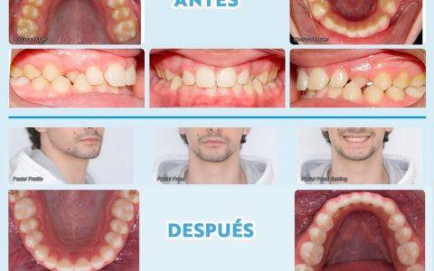 EVOLUCIÓN DE TRATAMIENTO DE ORTODONCIA POR MORDIDA CRUZADA En los casos en los que los dientes erupcionan por dentro de la arcada en una situación de oclusión cruzada, es muy importe “descruzar” esta mordida y resolverla ya que además de ser muy antiestético en la sonrisa, puede provocar problemas articulares. En este caso de este paciente que tenía un mordida cruzada en los caninos o colmillos superiores izquierdo y derecho, se le realizó una ortodoncia en una edad temprana, alcanzando mucha estabilidad y correcta oclusión, observando que se mantiene a lo largo de los años, como podemos observar en la fotos de antes del tratamiento y después de dicho tratamiento en el que se confirma su estabilidad, incluso pasados los años. … CLÍNICA DENTAL COTRINA. “SONRISAS PERFECTAS EN POZUELO DE ALARCÓN”. TRATAMIENTOS DE ESTÉTICA DENTAL. TRABAJAMOS CON LAS TENDENCIAS EN ORTODONCIA DEL SECTOR (ORTODONCISTAS EN POZUELO DE ALARCON). Los tratamientos de estética dental buscan mejorar la apariencia de la sonrisa, corrigiendo imperfecciones como manchas, fracturas, malposiciones o asimetrías. Estos tratamientos pueden incluir carillas, blanqueamiento, ortodoncia, coronas estéticas y cirugía de encías, entre otros. Consúltenos. Dirección: Avenida de Europa, 13. 28224 Pozuelo de Alarcón. Teléfono: 91 351 31 30. https://clinicadentalcotrina.com ... TIPOS DE TRATAMIENTOS: * #Ortodoncia: Corrige la posición de los dientes y los problemas óseos cuando el niño esta en crecimiento o si no está en crecimiento con cirugía #ortognática, para así lograr una sonrisa más armoniosa y una mejor mordida. * Diseño de sonrisa: Es un enfoque integral que combina varios tratamientos para lograr una sonrisa estética y personalizada, considerando la forma, tamaño, color y posición de los dientes, así como la línea de la encía. * #Carillas dentales: Son finas láminas que se adhieren a la parte frontal del diente para mejorar su forma, tamaño, color o posición. * #Coronas o Fundas : Cubren el diente dañado o deteriorado, restaurando su forma, tamaño y función, además de mejorar su apariencia estética. * #Blanqueamiento dental: Aclara el color de los dientes y unifica dicha tonalidad en toda la dentadura. * Cirugía plástica en la encía (Gingivoplastia) junto a la Periodoncia : Permite remodelar la encía para corregir problemas como una sonrisa gingival (demasiado visible) o encías irregulares y a la vez tratar cualquier tipo de enfermedad de la encía. * Reconstrucciones estéticas: Reparan dientes dañados por caries, fracturas o desgaste, utilizando materiales que imitan la apariencia natural del diente. #mordidacruzada #esteticadental #diseñodesonrisa #dentistaspozuelo #clinicasdentalespozuelo #ortodonciadental #ortodoncistapozuelo #tratamientosdentales #asimetriadental #alineadoresdentales