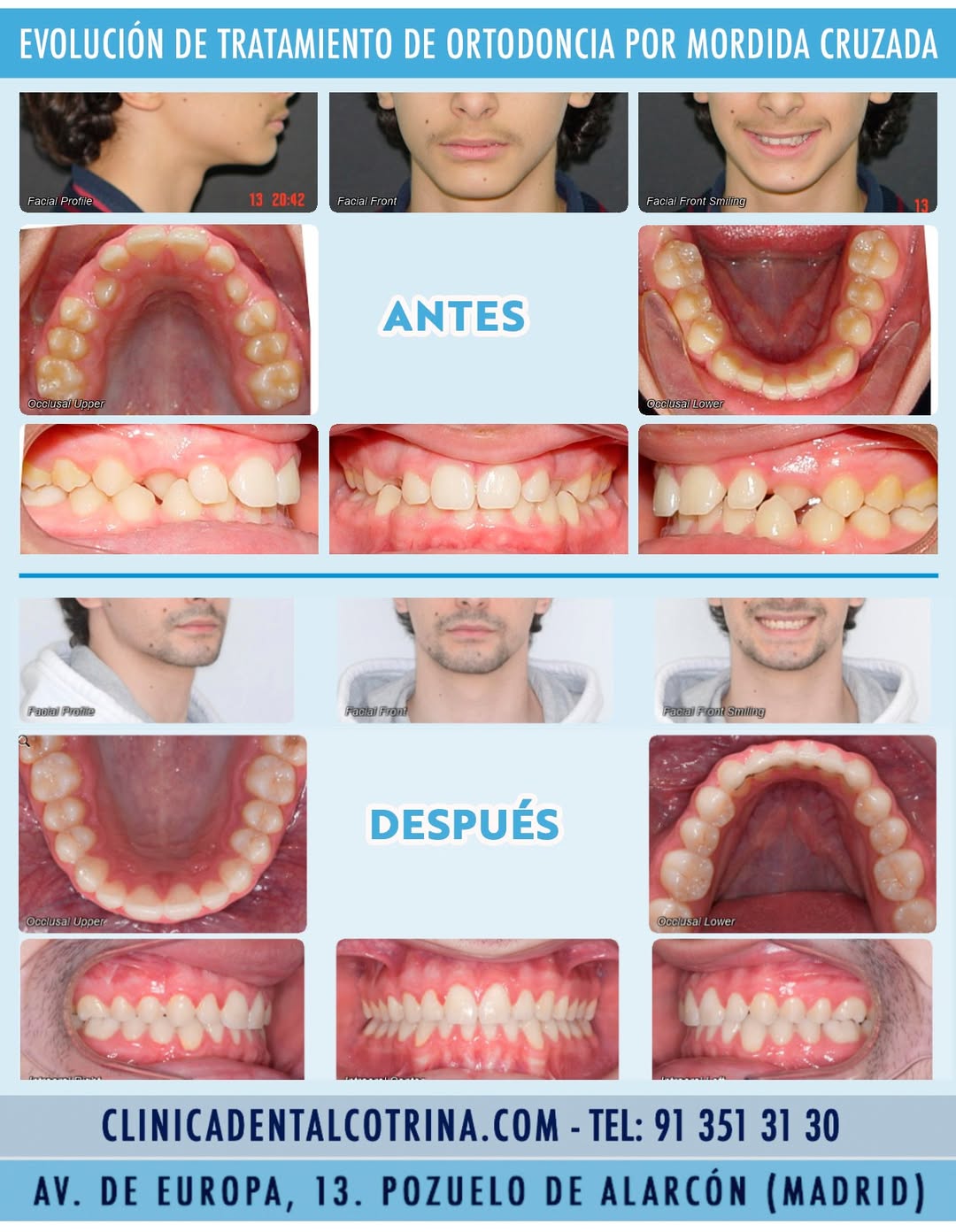 EVOLUCIÓN DE TRATAMIENTO DE ORTODONCIA POR MORDIDA CRUZADA En los casos en los que los dientes erupcionan por dentro de la arcada en una situación de oclusión cruzada, es muy importe “descruzar” esta mordida y resolverla ya que además de ser muy antiestético en la sonrisa, puede provocar problemas articulares. En este caso de este paciente que tenía un mordida cruzada en los caninos o colmillos superiores izquierdo y derecho, se le realizó una ortodoncia en una edad temprana, alcanzando mucha estabilidad y correcta oclusión, observando que se mantiene a lo largo de los años, como podemos observar en la fotos de antes del tratamiento y después de dicho tratamiento en el que se confirma su estabilidad, incluso pasados los años. … CLÍNICA DENTAL COTRINA. “SONRISAS PERFECTAS EN POZUELO DE ALARCÓN”. TRATAMIENTOS DE ESTÉTICA DENTAL. TRABAJAMOS CON LAS TENDENCIAS EN ORTODONCIA DEL SECTOR (ORTODONCISTAS EN POZUELO DE ALARCON). Los tratamientos de estética dental buscan mejorar la apariencia de la sonrisa, corrigiendo imperfecciones como manchas, fracturas, malposiciones o asimetrías. Estos tratamientos pueden incluir carillas, blanqueamiento, ortodoncia, coronas estéticas y cirugía de encías, entre otros. Consúltenos. Dirección: Avenida de Europa, 13. 28224 Pozuelo de Alarcón. Teléfono: 91 351 31 30. https://clinicadentalcotrina.com ... TIPOS DE TRATAMIENTOS: * #Ortodoncia: Corrige la posición de los dientes y los problemas óseos cuando el niño esta en crecimiento o si no está en crecimiento con cirugía #ortognática, para así lograr una sonrisa más armoniosa y una mejor mordida. * Diseño de sonrisa: Es un enfoque integral que combina varios tratamientos para lograr una sonrisa estética y personalizada, considerando la forma, tamaño, color y posición de los dientes, así como la línea de la encía. * #Carillas dentales: Son finas láminas que se adhieren a la parte frontal del diente para mejorar su forma, tamaño, color o posición. * #Coronas o Fundas : Cubren el diente dañado o deteriorado, restaurando su forma, tamaño y función, además de mejorar su apariencia estética. * #Blanqueamiento dental: Aclara el color de los dientes y unifica dicha tonalidad en toda la dentadura. * Cirugía plástica en la encía (Gingivoplastia) junto a la Periodoncia : Permite remodelar la encía para corregir problemas como una sonrisa gingival (demasiado visible) o encías irregulares y a la vez tratar cualquier tipo de enfermedad de la encía. * Reconstrucciones estéticas: Reparan dientes dañados por caries, fracturas o desgaste, utilizando materiales que imitan la apariencia natural del diente. #mordidacruzada #esteticadental #diseñodesonrisa #dentistaspozuelo #clinicasdentalespozuelo #ortodonciadental #ortodoncistapozuelo #tratamientosdentales #asimetriadental #alineadoresdentales